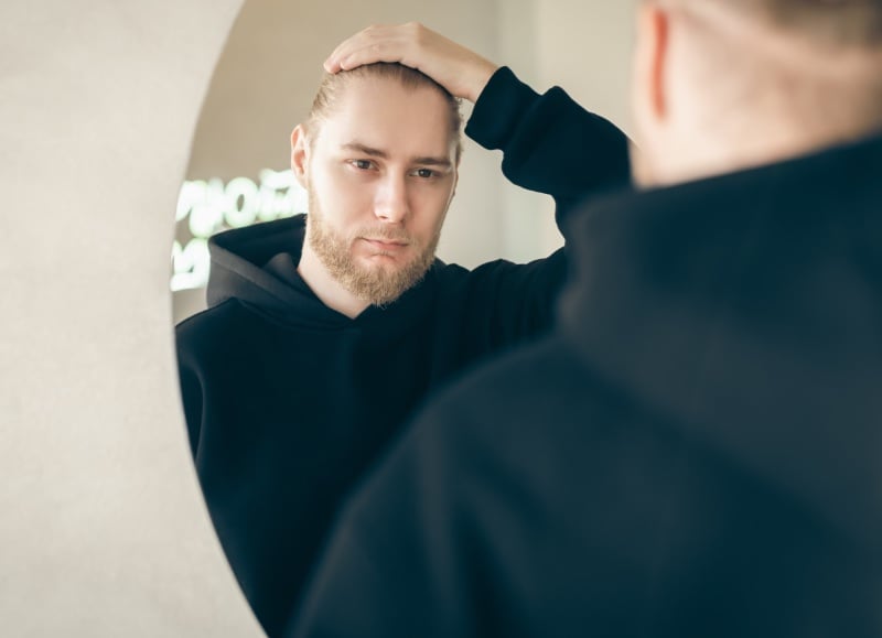 thinning hair men